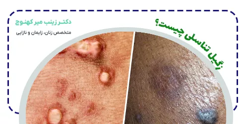 زگیل تناسلی چیست؟