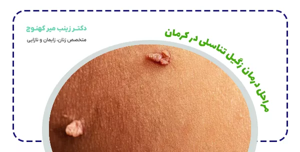 مراحل درمان زگیل تناسلی در کرمان