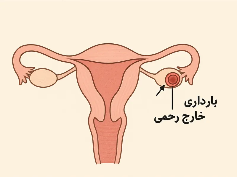 بارداری خارج رحمی