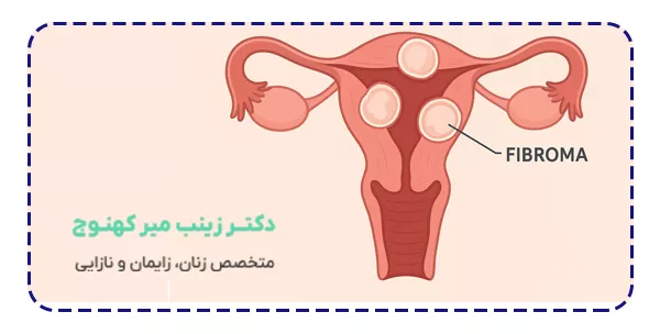 فیبروم رحم چیست فیبروم رحم چیست