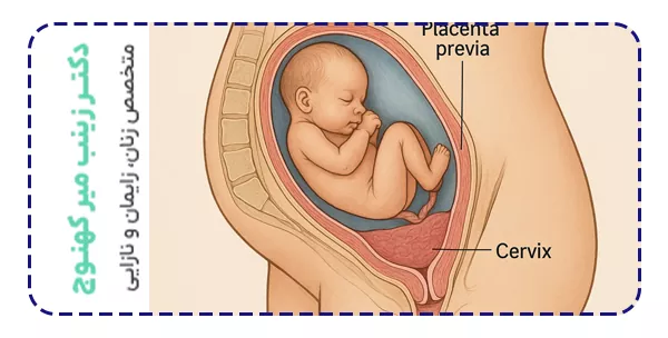 جفت سرراهی دقیقا چیست و چه انواعی دارد؟