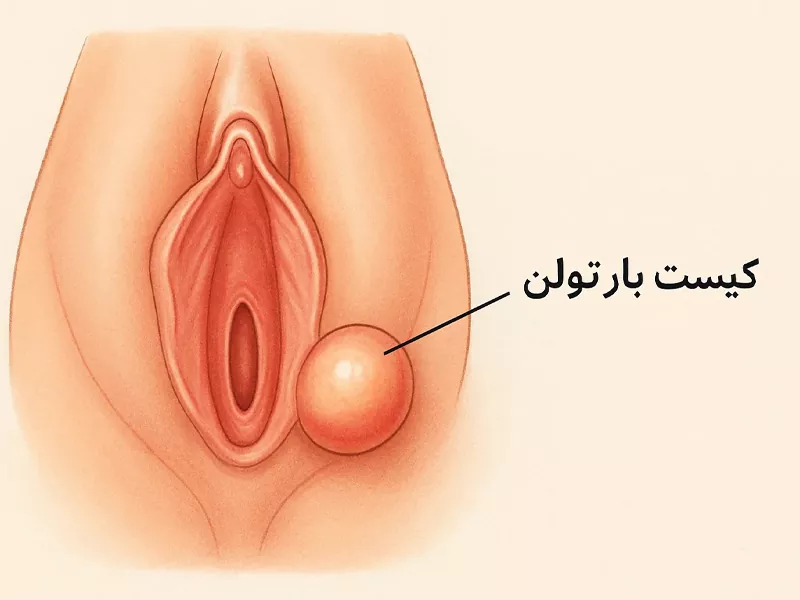 کیست بارتولن
