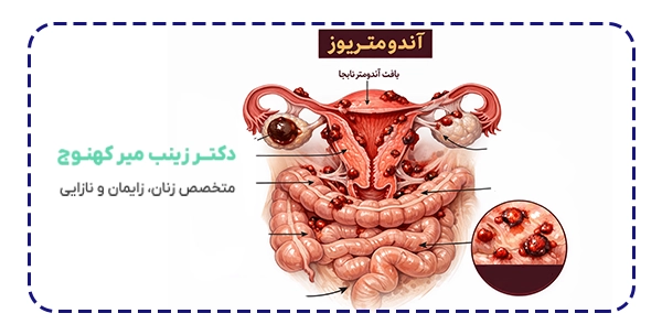 آندومتریوز چیست و چگونه ایجاد می شود؟