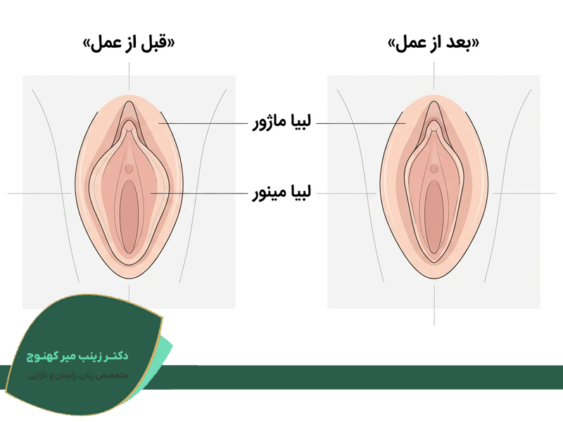 لابیاپلاستی